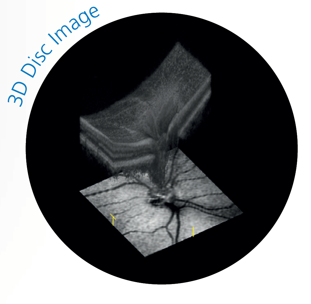 3D OCT scan of the optic disc used in glaucoma detection