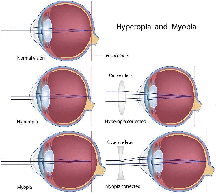 Animated diagram showing the difference between hyperopia and myopia