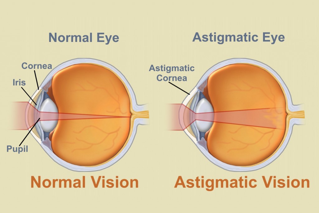 myopia astigmatism presbyopia