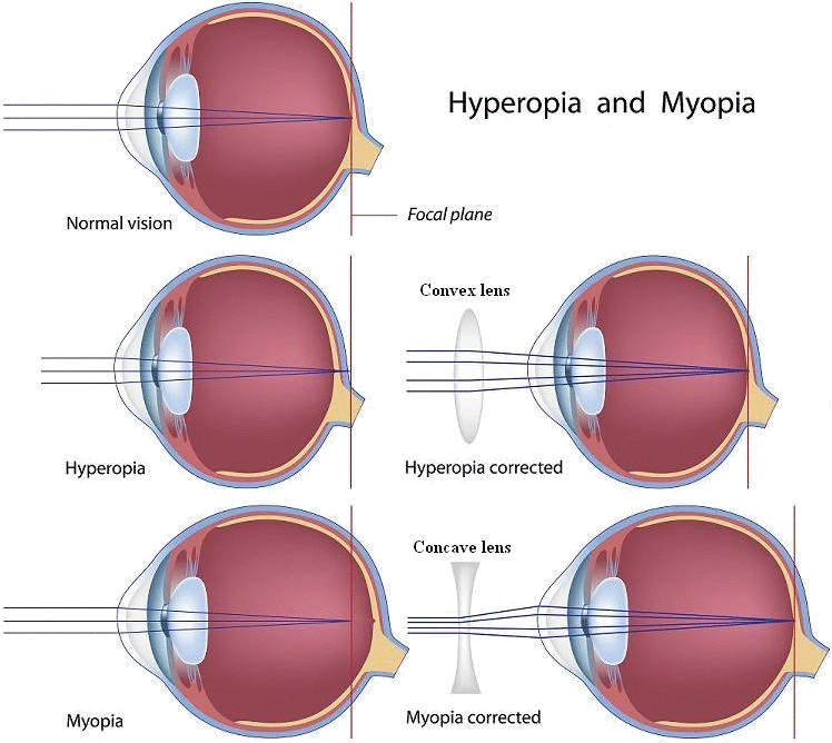 myopia hyperopia and presbyopia